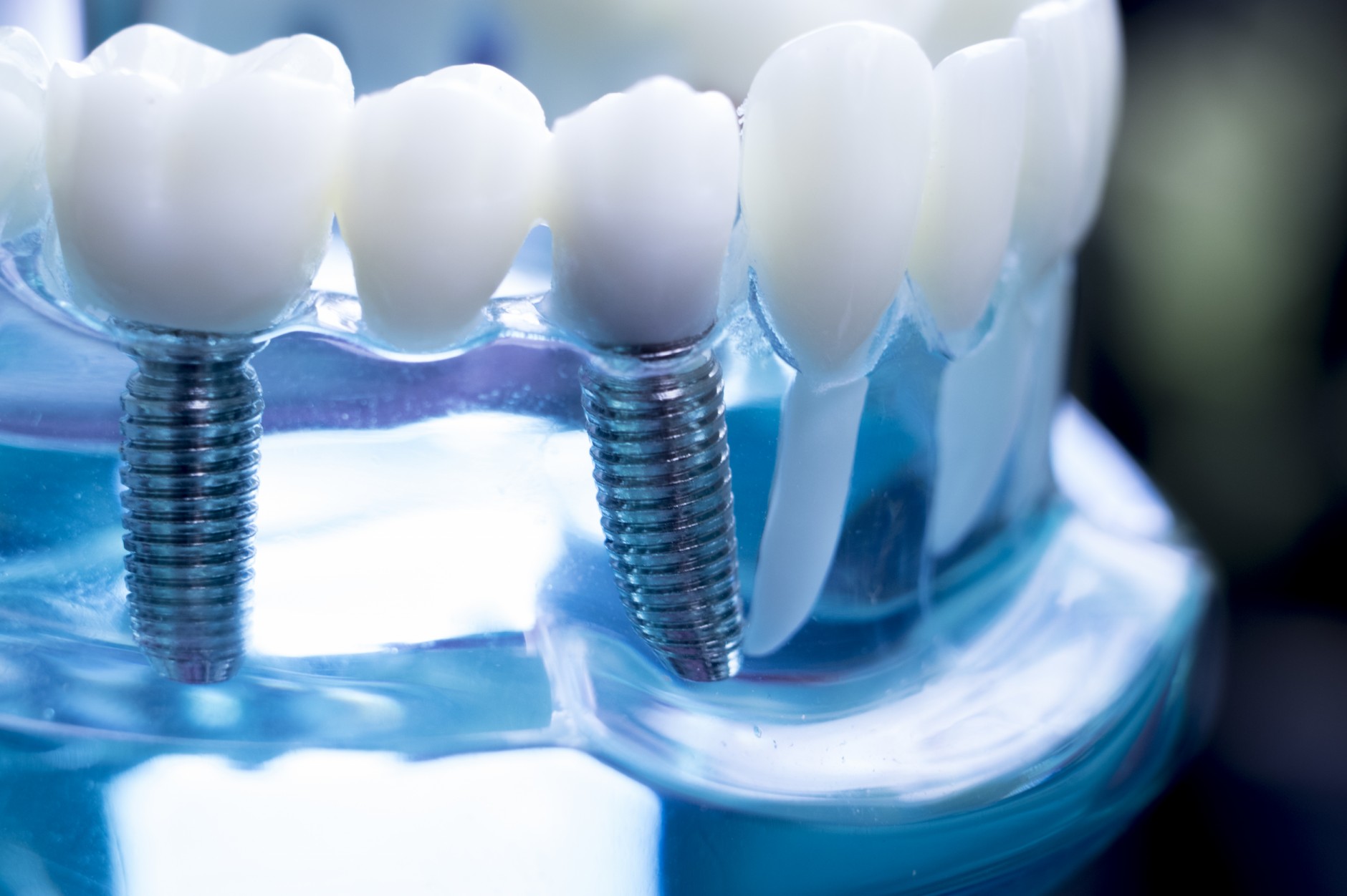 Zahnimplantate mit neuster Technologie